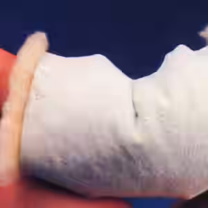 Ellenbogenschoner Bei Rheuma